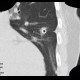 Chest tube, pleural drain: CT - Computed tomography
