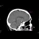 A tiny intracranial aneurysm on the branching ICA: CT - Computed tomography