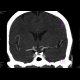 A tiny intracranial aneurysm on the branching ICA: CT - Computed tomography