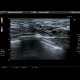 Intraductal papilloma, ectatic ducts: US - Ultrasound