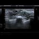 Intraductal papilloma, ectatic ducts: US - Ultrasound