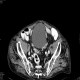Diverticular disease of sigmoid colon: CT - Computed tomography