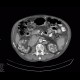 Xanthogranulomatous pyelonephritis: CT - Computed tomography