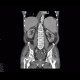 Xanthogranulomatous pyelonephritis: CT - Computed tomography