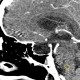 Empty sella, hypophysis: CT - Computed tomography