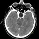Empty sella, hypophysis: CT - Computed tomography