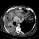 Empyema of thorax: CT - Computed tomography