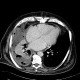 Empyema of thorax: CT - Computed tomography