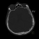 Frontal hyperostosis, endocraniosis: CT - Computed tomography
