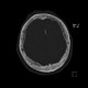 Frontal hyperostosis, endocraniosis: CT - Computed tomography