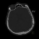 Frontal hyperostosis, endocraniosis: CT - Computed tomography