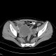 Endometriosis, ovarian endometriosis: CT - Computed tomography