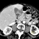 Enteric cyst of duodenum: CT - Computed tomography