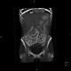 Post-radiation enteritis, enterography, positive contrast, VRT: CT - Computed tomography