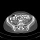 Post-radiation enteritis, enterography, positive contrast: CT - Computed tomography
