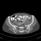 Post-radiation enteritis, enterography, positive contrast: CT - Computed tomography