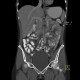 Post-radiation enteritis, enterography, positive contrast: CT - Computed tomography
