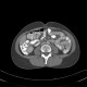 Post-radiation enteritis, enterography, positive contrast: CT - Computed tomography