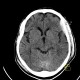 Epidural hematoma, subarachoid hemorrhage, cerebral contusion, skull fissure: CT - Computed tomography