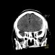 Epidural hematoma, subarachoid hemorrhage, cerebral contusion, skull fissure: CT - Computed tomography