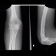 Elbow effusion, fat pad, sail sign: X-ray - Plain radiograph