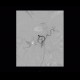 Diverticular bleeding, embolisation: AG - Angiography