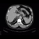 Diverticular bleeding, embolisation: CT - Computed tomography