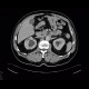 Diverticular bleeding, embolisation: CT - Computed tomography