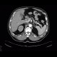 Diverticular bleeding, embolisation: CT - Computed tomography