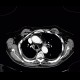 Empyema of thorax: CT - Computed tomography