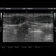 Endometriosis of the abdominal wall: US - Ultrasound
