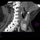 Thyroid nodule, hypervascular: CT - Computed tomography