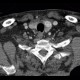 Thyroid nodule, hypervascular: CT - Computed tomography
