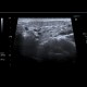 Epidemic parotitis: US - Ultrasound