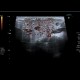 Epidemic parotitis: US - Ultrasound