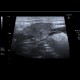 Epidemic parotitis: US - Ultrasound