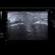 Epidemic parotitis: US - Ultrasound