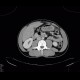 Fracture of thoracic vertebra, epidural hematoma of the spinal canal: CT - Computed tomography