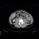Fracture of thoracic vertebra, epidural hematoma of the spinal canal: CT - Computed tomography