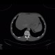 Fracture of thoracic vertebra, epidural hematoma of the spinal canal: CT - Computed tomography