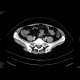 Epiploic appendagitis: CT - Computed tomography