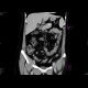 Epiploic appendagitis: CT - Computed tomography