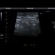 Epiploic appendagitis: US - Ultrasound