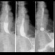 Oesophagitis, transpyloric prolapse: RF - Fluoroscopy