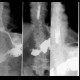 Oesophagitis, transpyloric prolapse: RF - Fluoroscopy