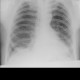 Lung fibrosis, basal: X-ray - Plain radiograph