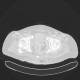 Gangrene of perineum and ischiorectal fossa, Fournier gangrene: CT - Computed tomography