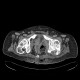 Gangrene of perineum and ischiorectal fossa, Fournier gangrene: CT - Computed tomography