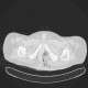 Gangrene of perineum and ischiorectal fossa, Fournier gangrene: CT - Computed tomography