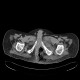 Gangrene of perineum and ischiorectal fossa, Fournier gangrene: CT - Computed tomography